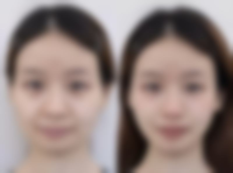 二、蒙克脸能去掉眼袋吗？从原理上分析