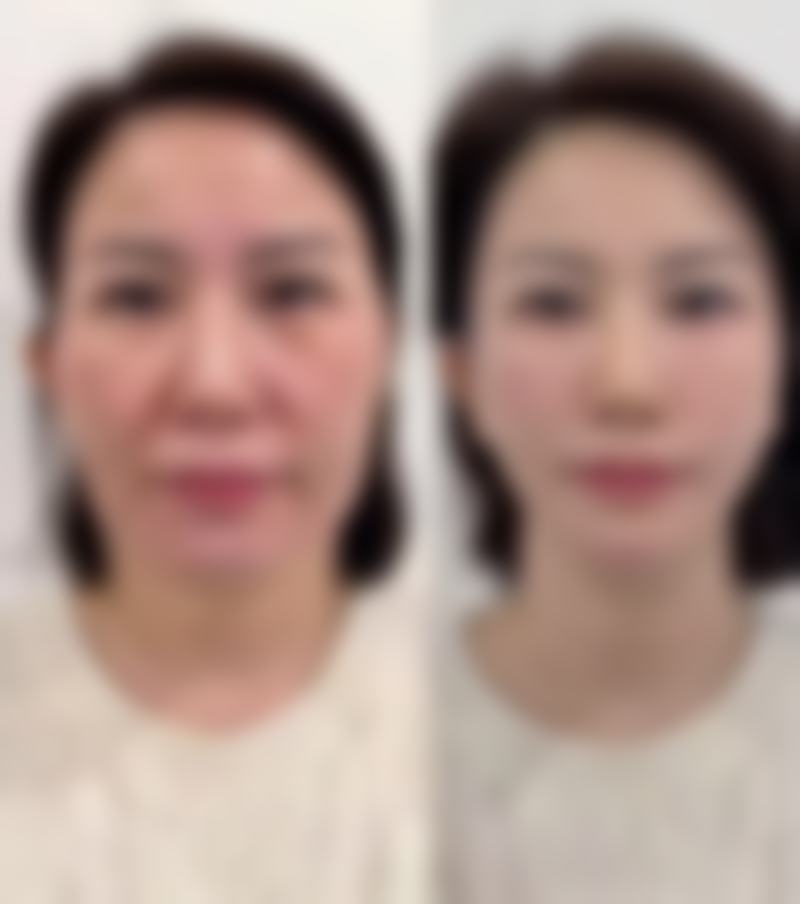 二、自体隆鼻的材料特点