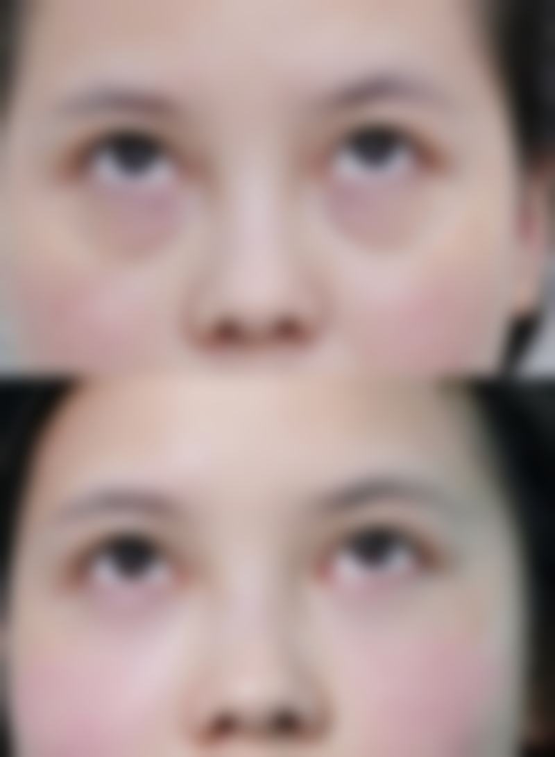四、自体隆鼻的术后护理