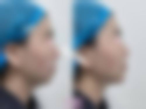 八、上海诠韩医疗美容整形医院真实的患者评价
