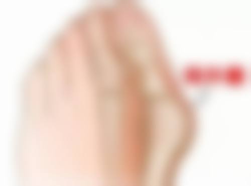 三、陈旧凸起疤痕去除之手术治疗