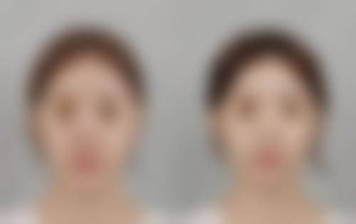 陈旧凸起疤痕怎么去除？药物、物理、手术治疗方法及对应图片解析来了
