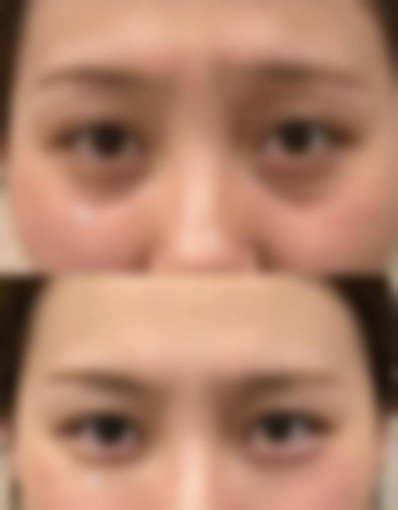 五、线提升隆鼻修复期间的其他注意事项