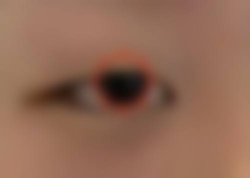 一、双眼皮发痒可能是过敏在作祟
