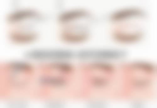 三、如何延长拉双眼皮的保持时间