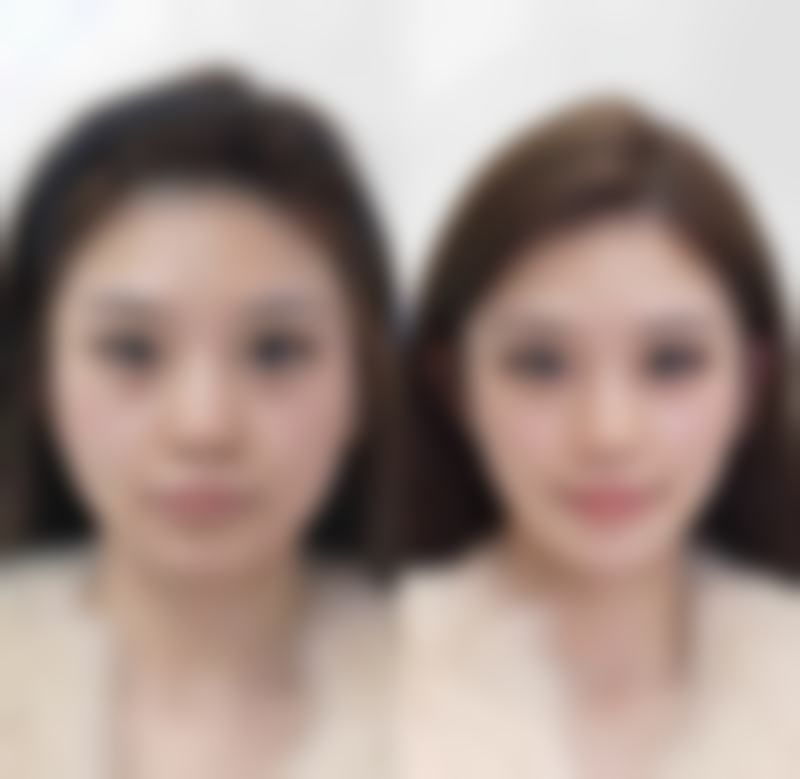 四、拉双眼皮保持时间的实际实例分析
