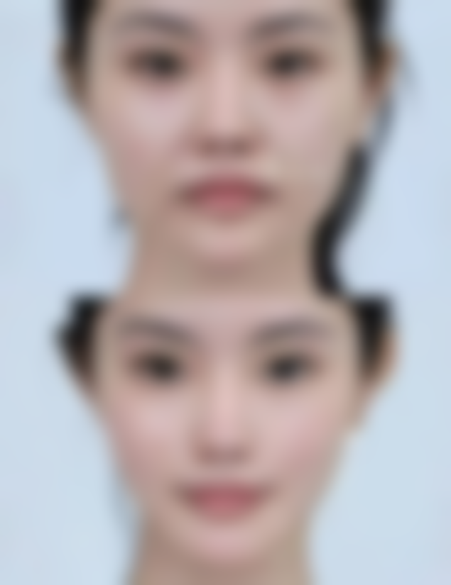 三、吸脂丰胸术后的注意事项