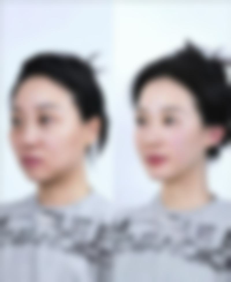 五、什么去眼袋的成效好?术后注意事项