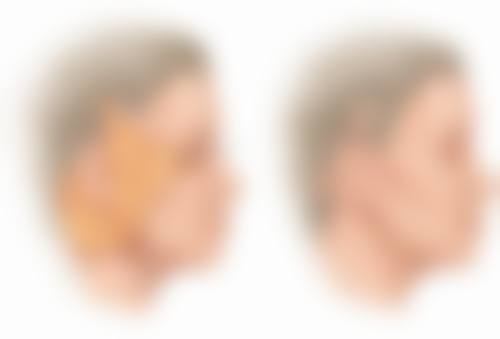 五、谢顶种植头发的手术方式