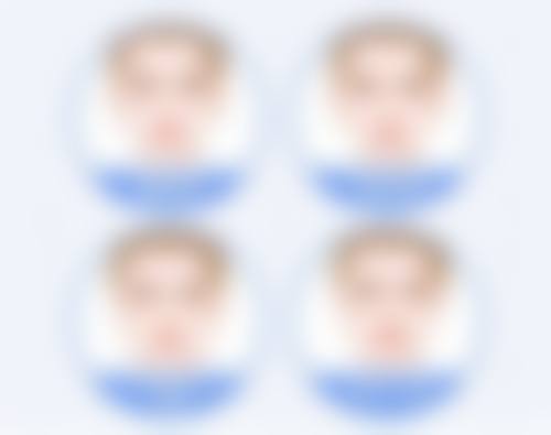 五、肿眼泡割双眼皮抽脂的实例分析