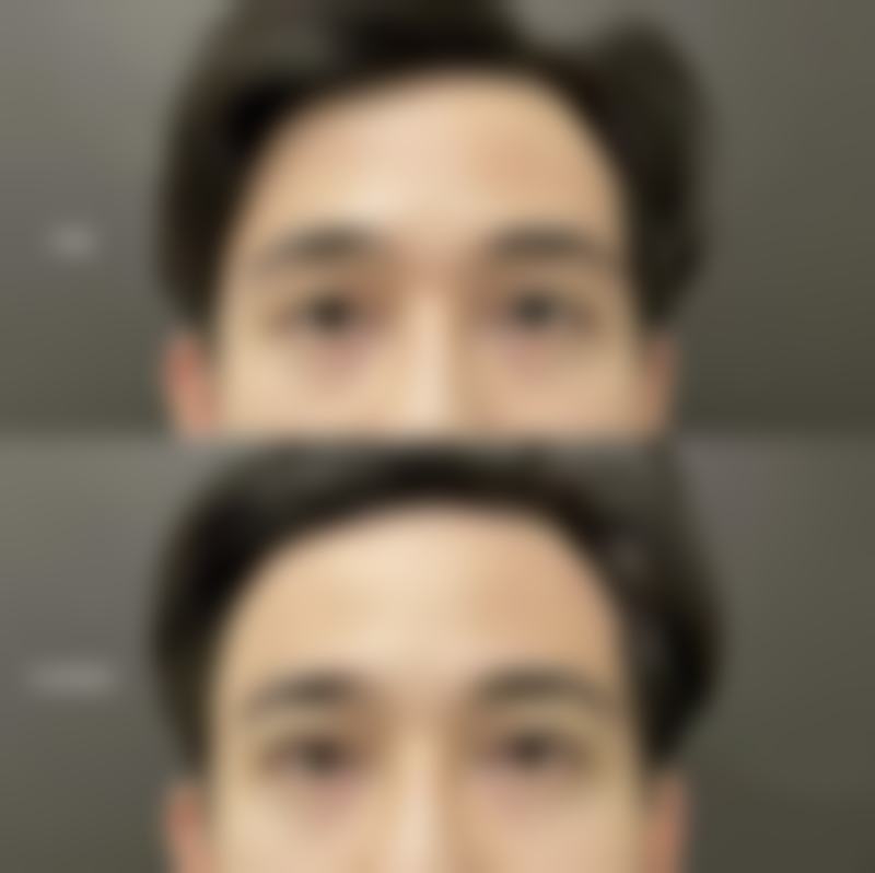 一、切除眼袋后增生的原因及表现