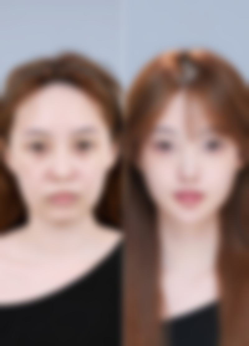 五、切除眼袋后增生修复的日常护理