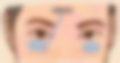 三、近视眼割双眼皮的术后注意事项