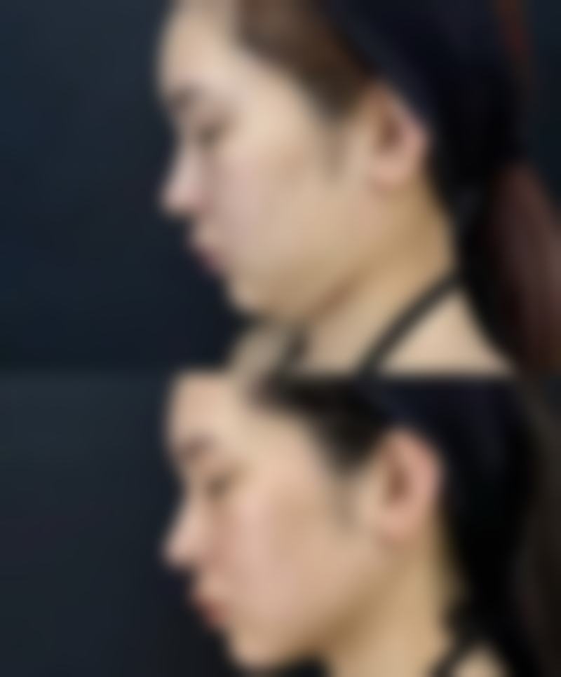 四、相关眼部整形问题科普