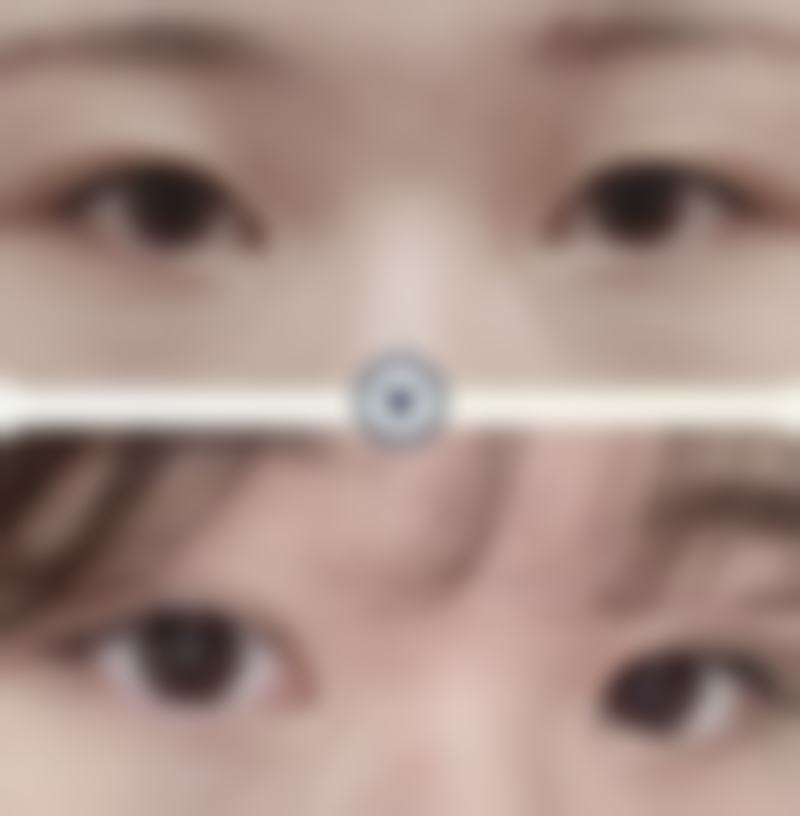 二、十几年的烫伤疤痕其他修复方法