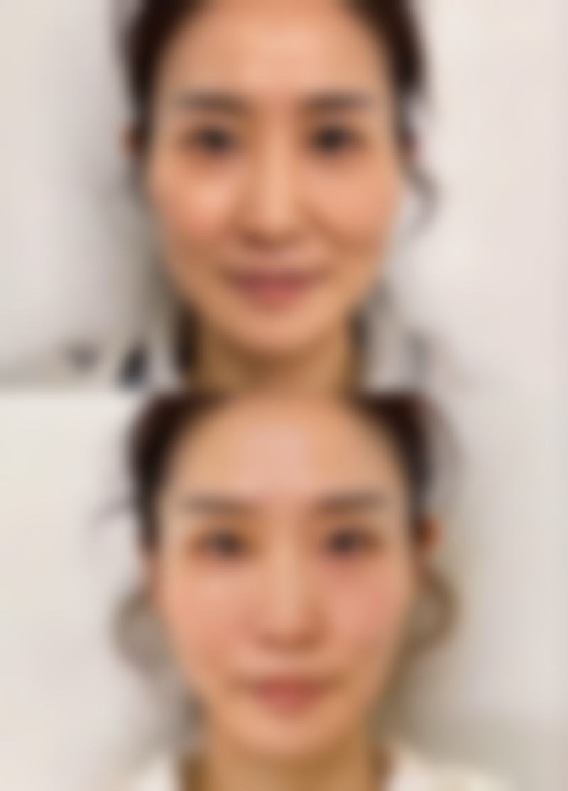 四、如何去除烧伤留下的疤痕之日常护理