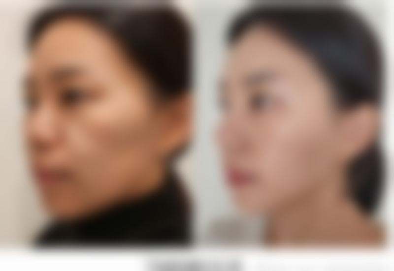 六、考虑手术治疗避免疤痕增生