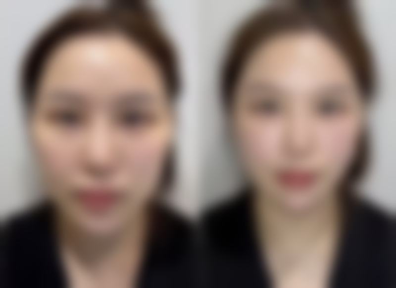 一、鼻子的疤痕怎么去之药物治疗