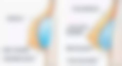 五、全切双眼皮术后不输液的护理要点