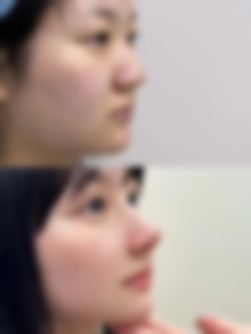 三、隆胸假体傲诺拉和娜绮丽的价格区别