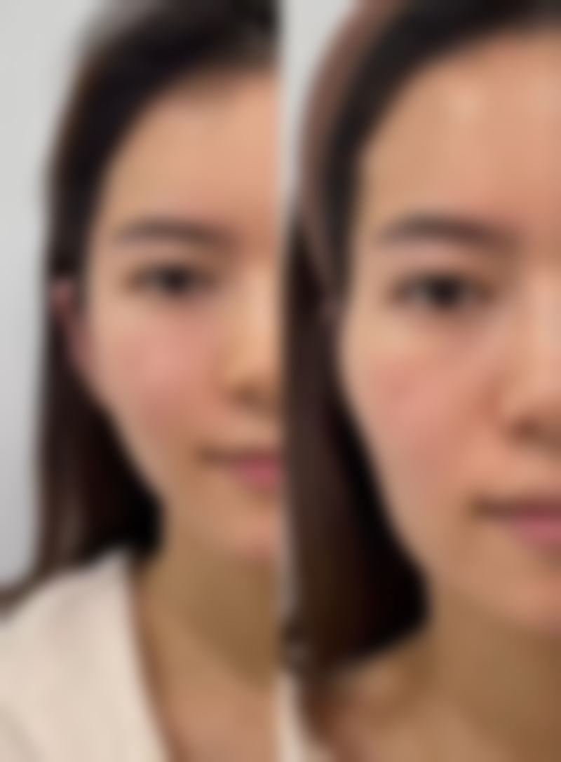 一、一般疤痕治疗之药物治疗
