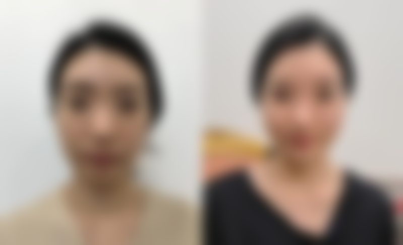 五、假体隆胸后母乳喂养的实际实例