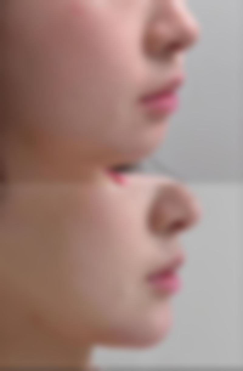 三、260cc假体隆胸的手术过程