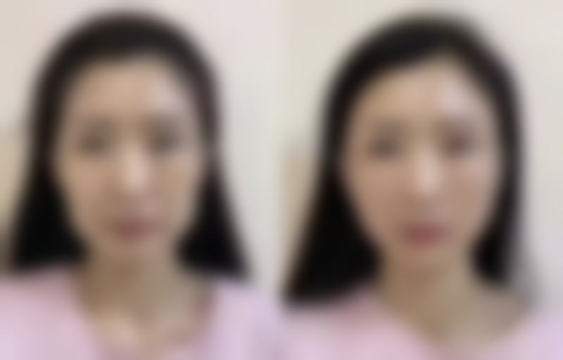 五、怎么去掉增生疤痕疙瘩之激光治疗