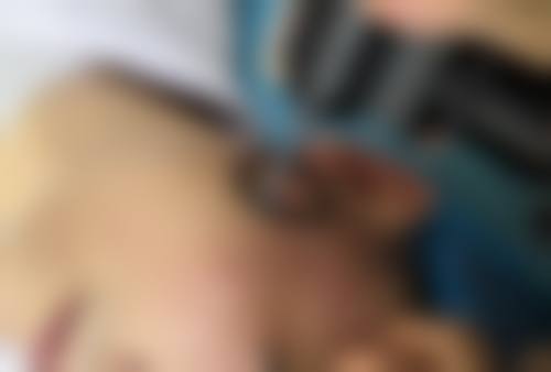二、药物治疗切痣后疤痕增生
