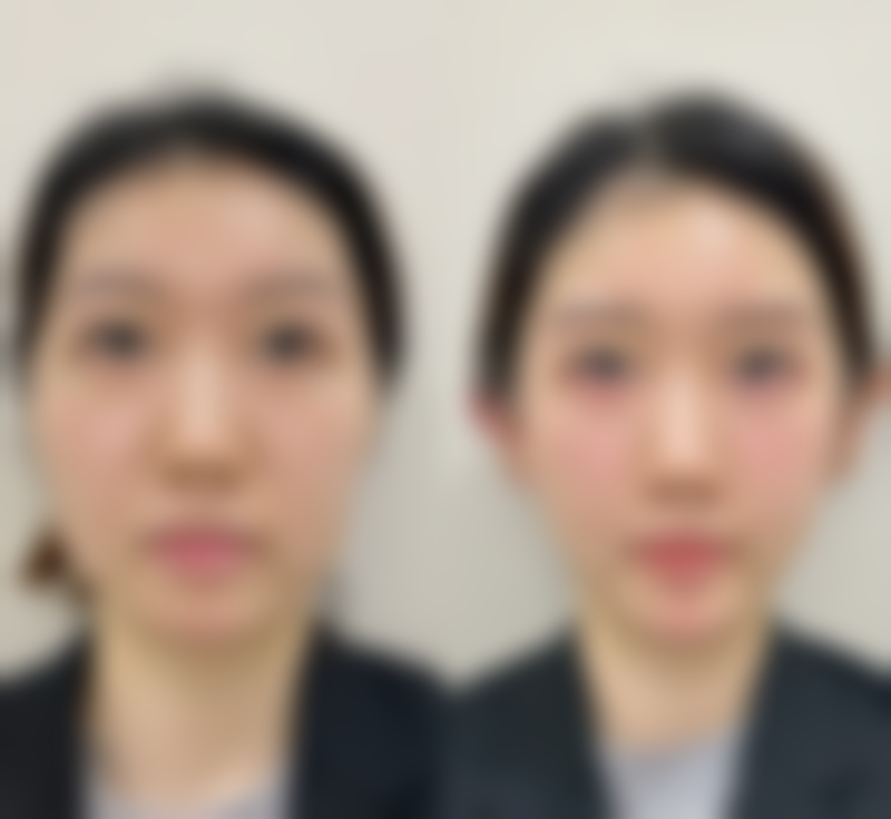 四、取出假体的正确时机