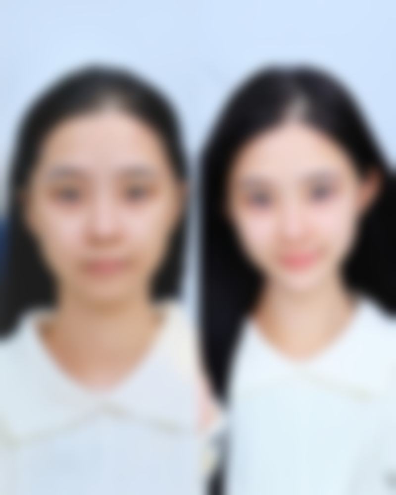 三、针对色素沉着的药物