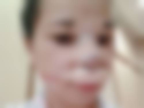 三、额头上凹陷坑疤痕的修复方法