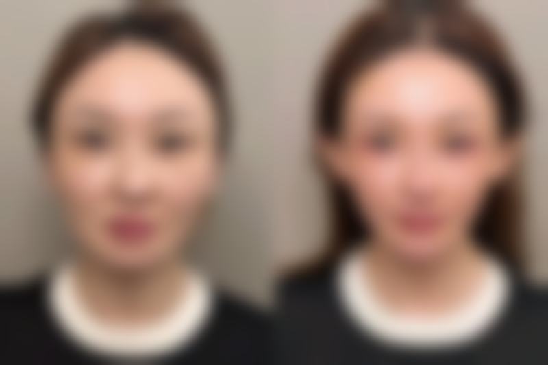 四、如何避免全切双眼皮后上眼皮松弛