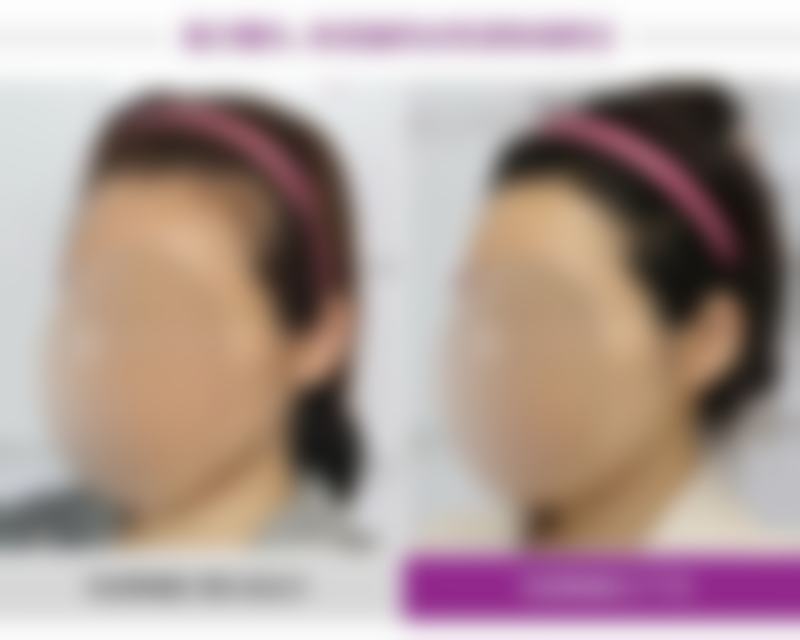 四、怎么缓解眼袋皱纹:治疗后的注意事项