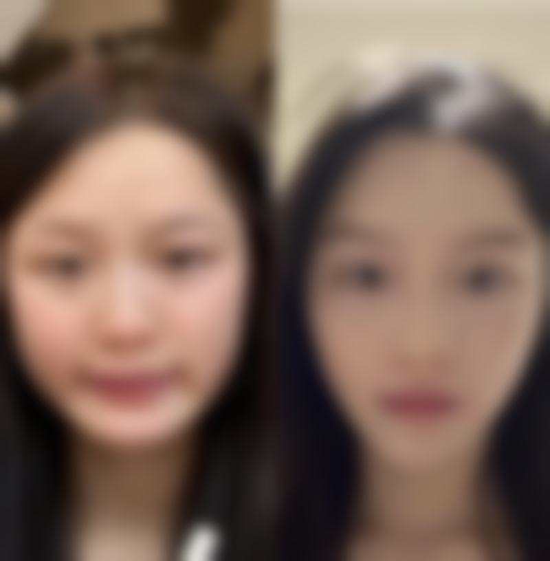 六、不同人群凸疤痕的治疗