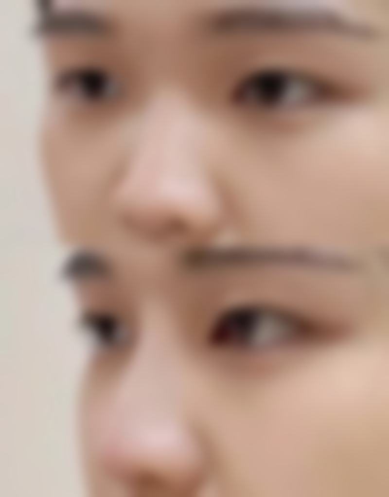 二、肋骨隆鼻手术概述