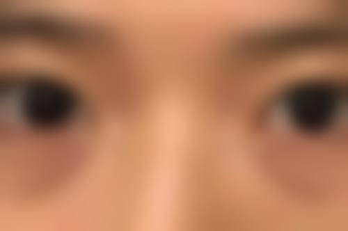 三、双眼皮埋线的危害和后遗症