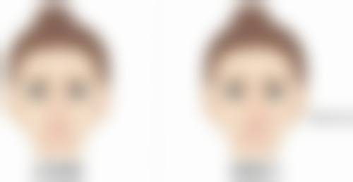 五、修复手术的注意事项