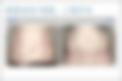 五、割了双眼皮修复后的注意事项