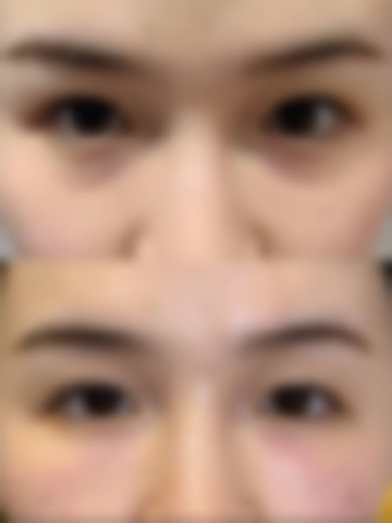 三、如何降低种植头发的副作用