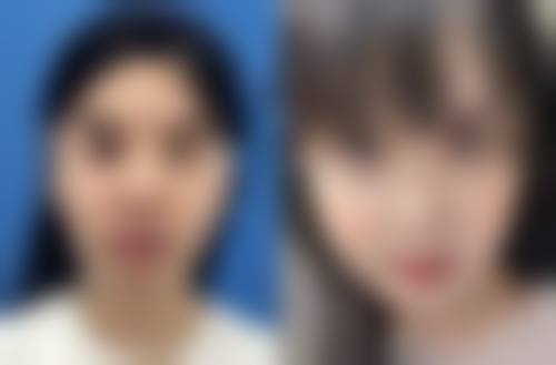 五、为什么有时候是单眼皮有时候是双眼皮之遗传规律