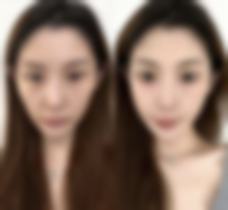 二、为什么有时候是单眼皮有时候是双眼皮之病理性因素