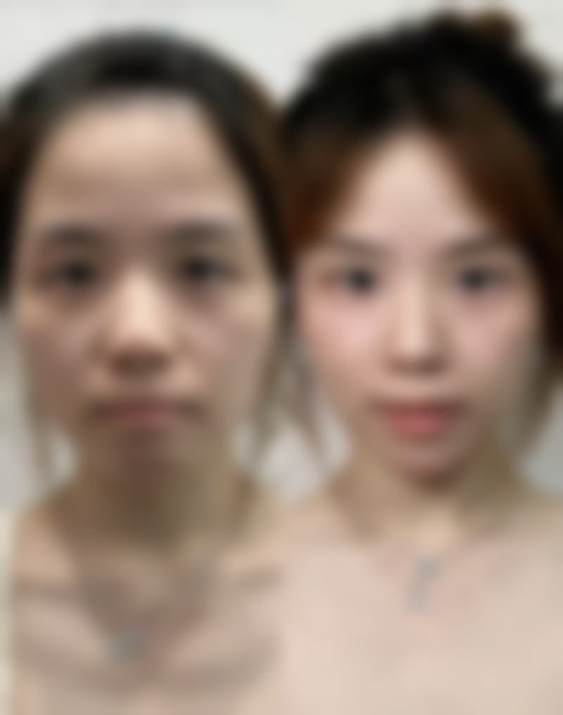 六、用ve可以去眼袋吗？其他去眼袋方法
