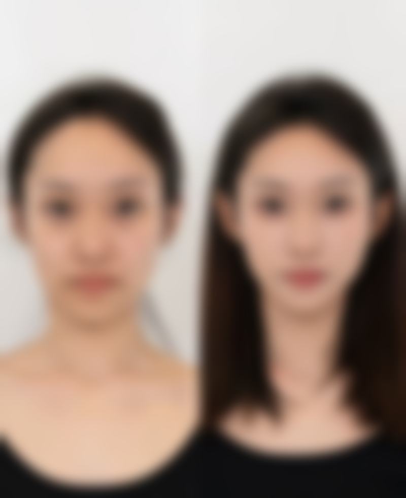 三、割双眼皮加开眼角多久修复?影响修复时间的因素