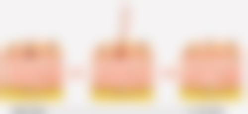 三、隆胸假体取出后的修复时间