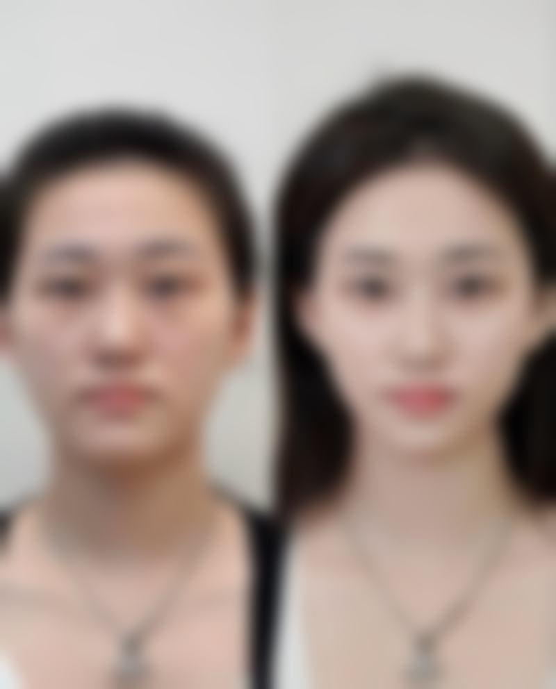 四、肋骨隆鼻取出后的护理