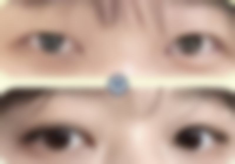 三、儿童如何修复疤痕之手术治疗