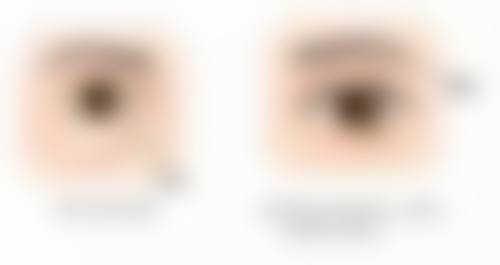 五、德国热熔技术去眼袋的注意事项