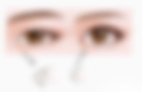 三、全切双眼皮手术修复的不同阶段表现