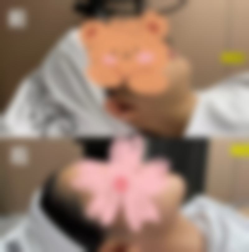 术后一个月,我完全被成效震撼了。